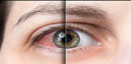 If you want eye health, use these easily available vitamins. If you want eye health, use these easily available vitamins.